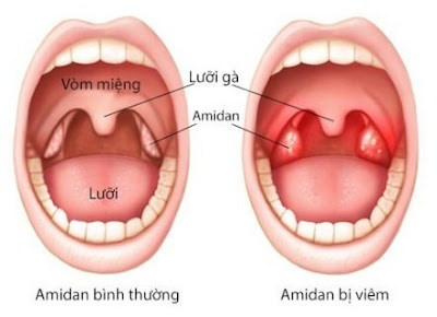 Vị trí của amidan bị viêm Vị trí của amidan bị viêm