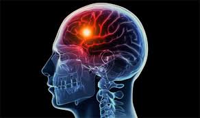 Cara Cepat Mengobati Sakit Stroke, apa penyebab sakit stroke ringan?, Cara Alami Untuk Mengobati Penyakit Stroke Ringan