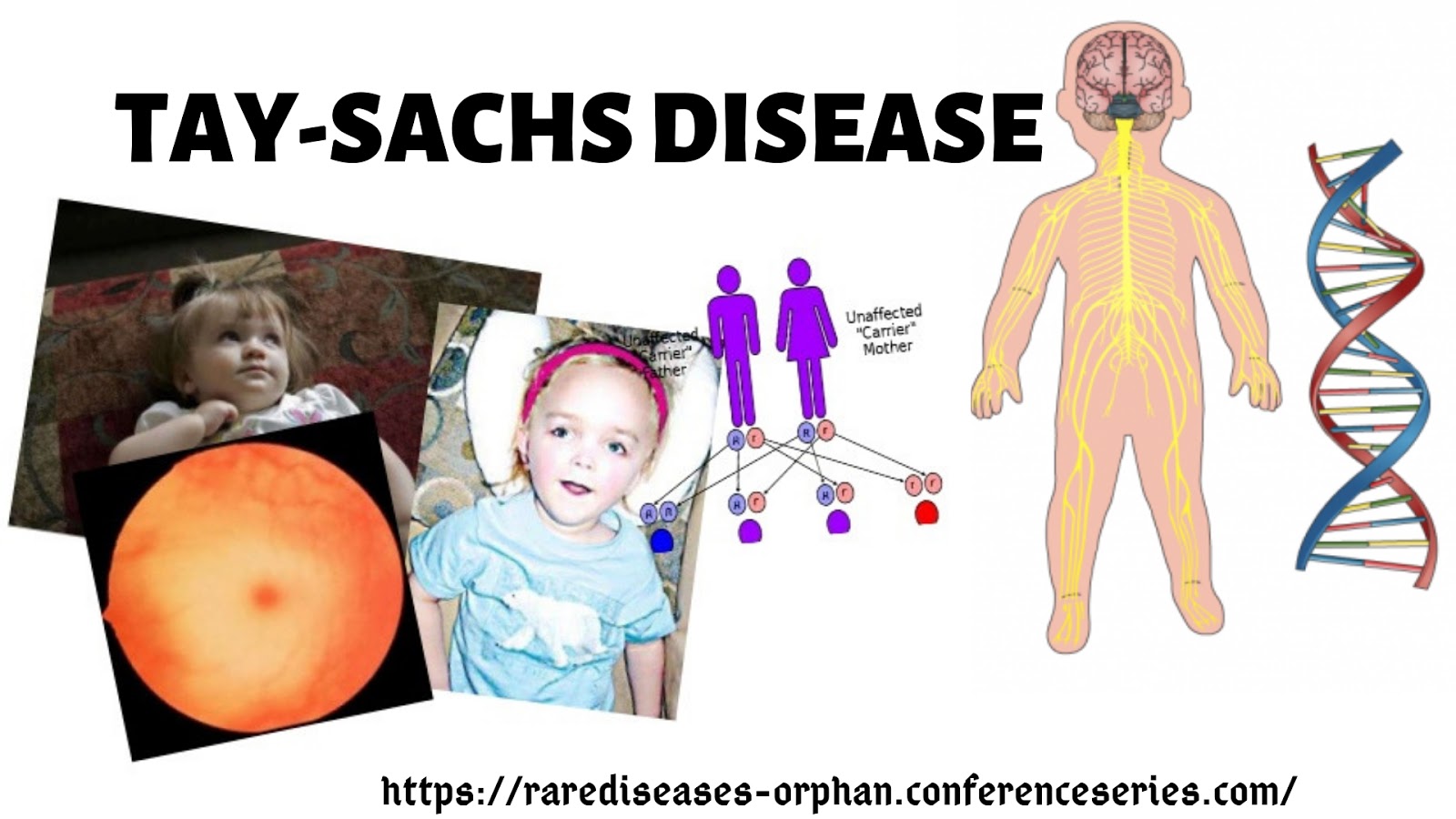 Read This Controversial blog And Find Out More About TAY-SACHS DISEASE