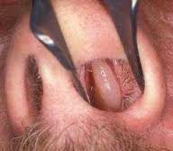 Cara Mengobati Polip Hidung dengan Herbal Cara Mengobati Polip Hidung dengan Herbal