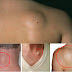 Avoid Your Surgery: Recipe for Removal of Fatty Tissue (Lipoma) in Just 8 Days