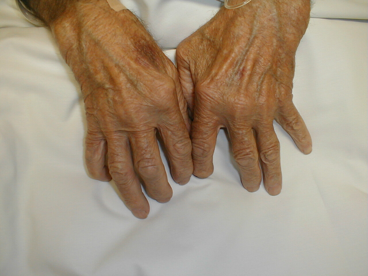 Clinical picture of Rheumatoid arthritis , symptoms and signs
