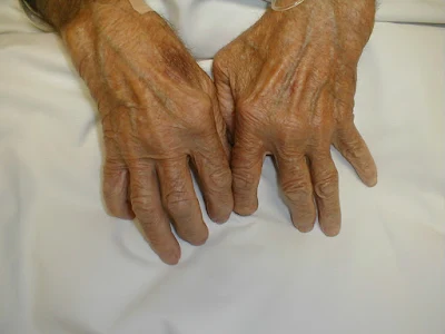 rheumatoid arthritis hand deformed