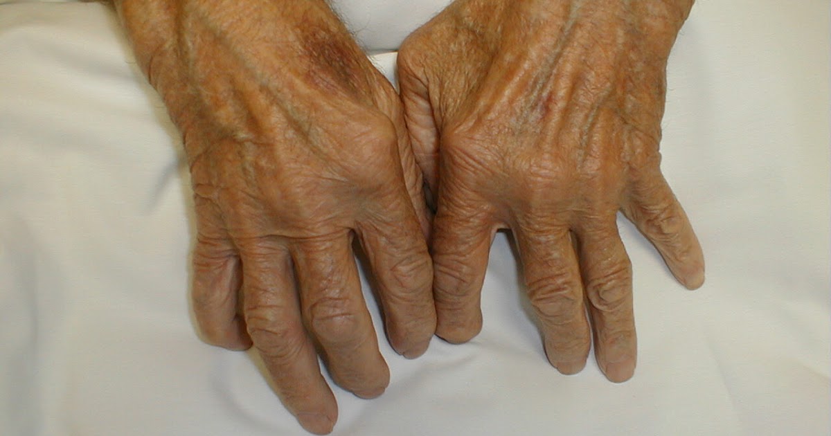 Clinical Picture Of Rheumatoid Arthritis Symptoms And Signs Med2date