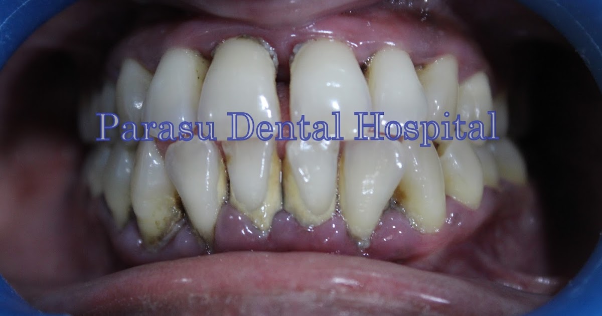 Dental Xray center in medavakkam Laser Gum ( LANAP ) Treatment in