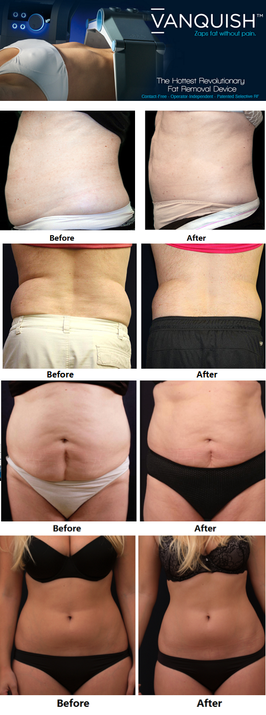 Weight loss with Panbesy, Garbaslim & Vanquish and Some of my ramblings