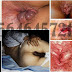 Cara Menghentikan Berak atau BAB Berdarah Segar thumbnail