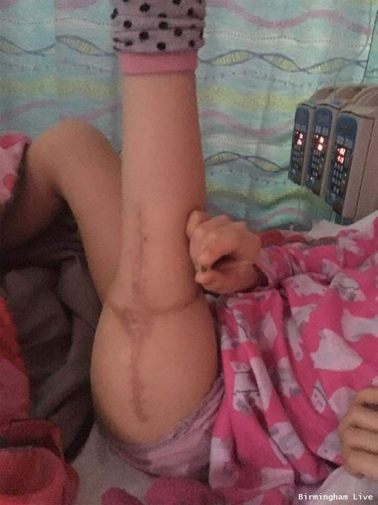 Menina tem perna reimplantada ao contrário depois de amputação - entenda esse caso curioso -  Img 1
