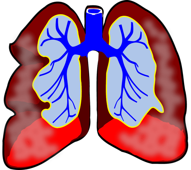 pulmonary embolism treatment lung blood clot prevention cardiovascular health