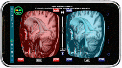 reconstruction images of the ventricular system referenced with MRI 