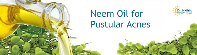 Neem and tea tree oil fights acne