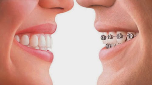Niềng răng sứ - cách để lấy lại hàm răng trắng đẹp Nieng-rang-va-chinh-nha-1