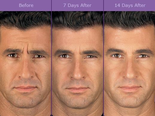 Cosmetic Surgery, Dermal Fillers, and Botox for Men | Cosmetic Surgery ...