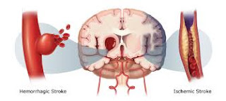 Cara Ampuh Menyembuhkan Penyakit Stroke Cara Ampuh Menyembuhkan Penyakit Stroke