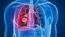 Malignant mesothelioma demystified Malignant mesothelioma demystified