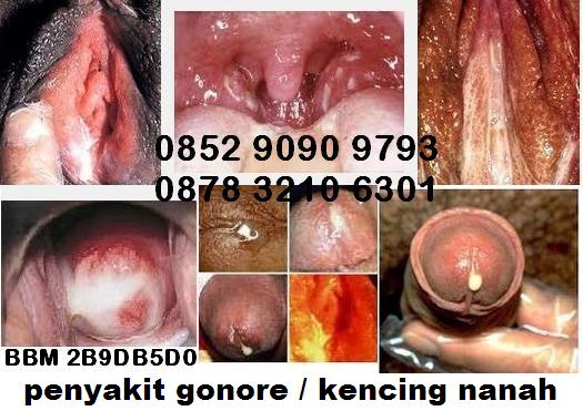 Pengobatan Kelamin Keluar Nanah Ampuh Menggunakan Obat Apa Pengobatan Kelamin Keluar Nanah Ampuh Menggunakan Obat Apa