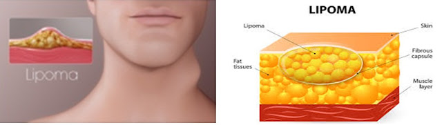 Obat Lipoma Ampuh, Cara Menghilangkan Benjolan Lipoma Tanpa Operasi Terbukti Tuntaskan Sampai Ke Akar