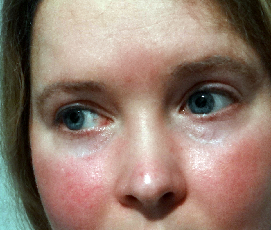 Scarlet Letters, dealing with vascular rosacea, face flushing, burning