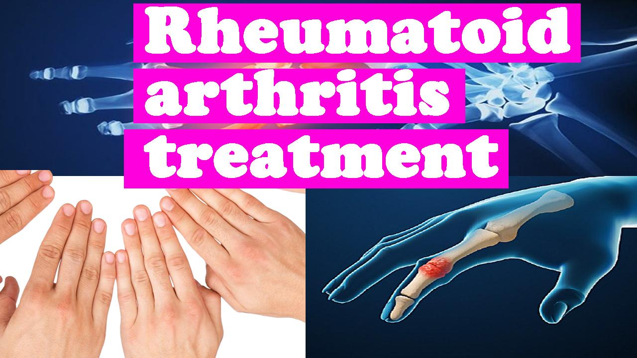 Rheumatoid Arthritis Home Remedies for Rheumatoid Arthritis