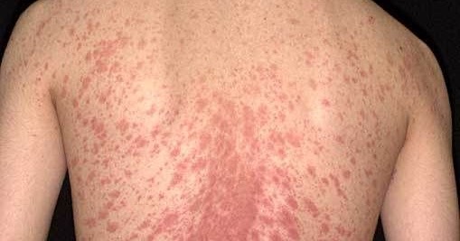 pityriasis rosea christmas tree pattern www pixshark com pityriasis rosea christmas tree pattern www pixshark com
