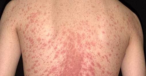 Pityriasis rosea (Christmas tree rash) skin disease causes ...