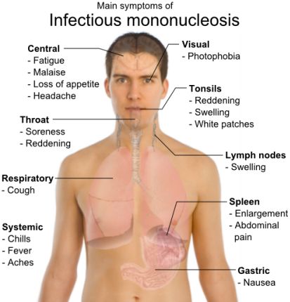 Infectious Mononucleosis