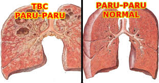 Tbc Dan Paru Paru Tbc Dan Paru Paru