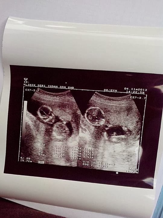 Wife Saya Sudah Pregnant 4 Bulan Baby Kembar Ke 