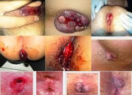 Foto Salep Ampuh Benjolan di Bibir Anus Meradang