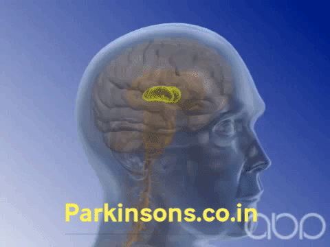 Болезнь Паркинсона gif. Болезнь Паркинсона гифка. Люди с заболеванием Паркинсона. Глубокая стимуляция мозга.