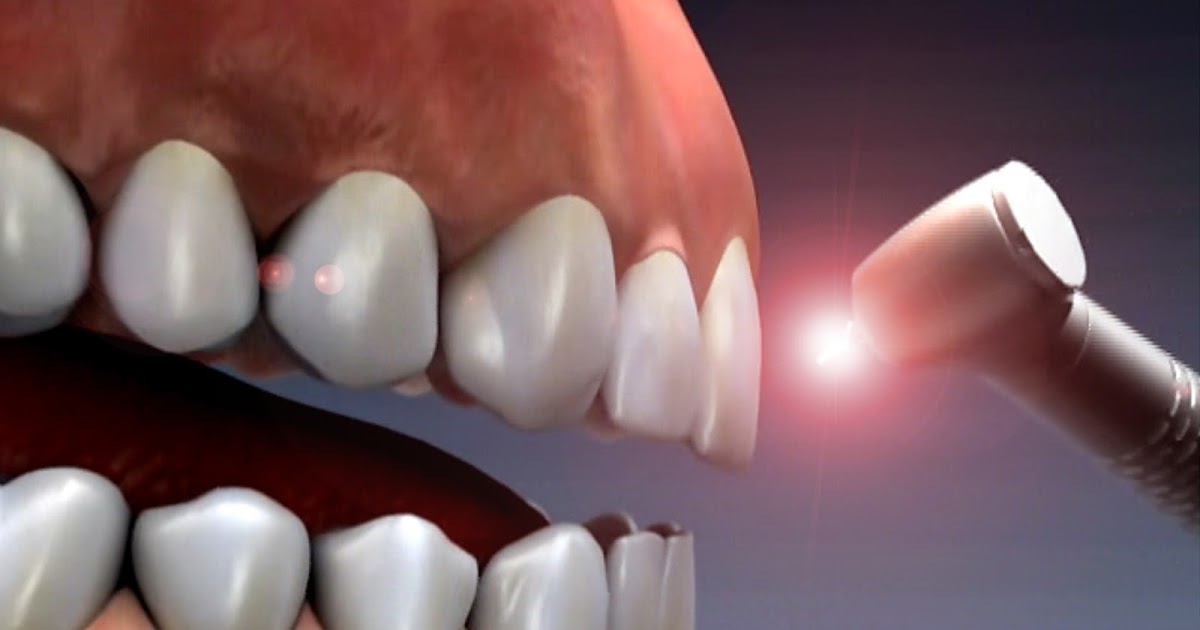 дарсонвализация десны. препарирование зубов лазером. воздушно-абразивный метод в стоматологии. пародонтоз лечение лазером. пародонтоз лечение лазером.