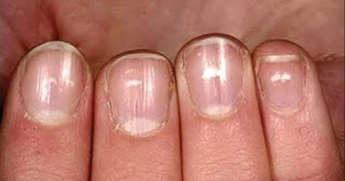 Белые следы на ногтях. Онихорексис, ониходистрофия. Онихорексис трахионихия. Ониходистрофия - онихолизис.