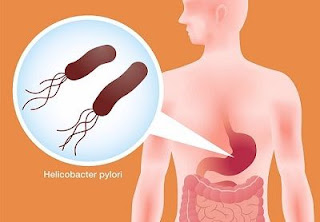 Helicobacter pylori causa cáncer gástrico. " "