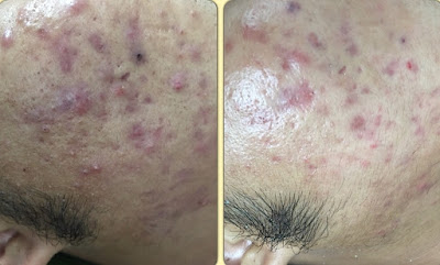Mụn trứng cá là gì?