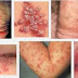 Cara Menghilangkan Herpes Secara Tradisional