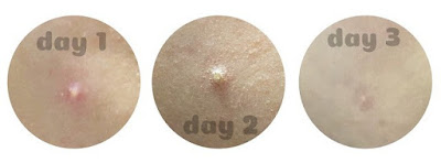 Hướng sử dụng Gel trị mụn Vivantskincare 5‰ Gel Medication hiệu quả Hướng sử dụng Gel trị mụn Vivantskincare 5‰ Gel Medication hiệu quả