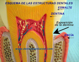 <Img src="esquema-exposición-dentina.jpg" width = "2464" height "1944" border = "0" alt = "Cuello dental con dentina expuesta">
