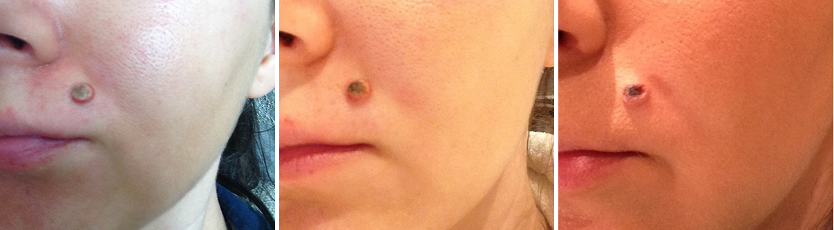 Skin Concerns] Removing mole without scar : r/SkincareAddiction