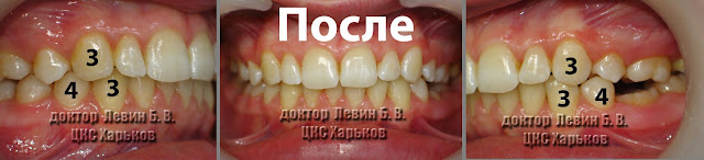 Ортогнатический (правильный) тип смыкания боковых зубов Благодаря лечению с удалением, боковые зубы смыкаются правильно.
