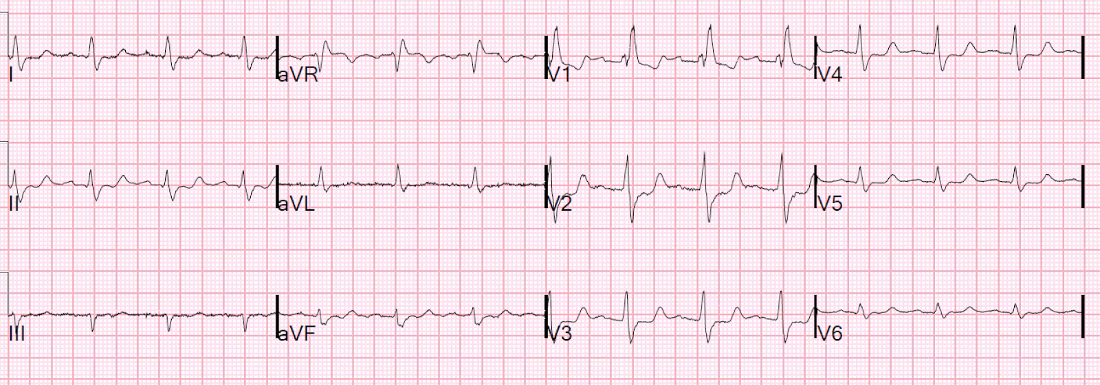 dr smiths ecg blog right bundle branch block and st rbbb ecg
