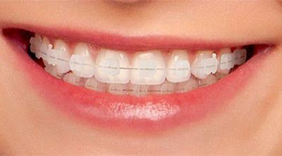 Hiệu quả của việc niềng răng
