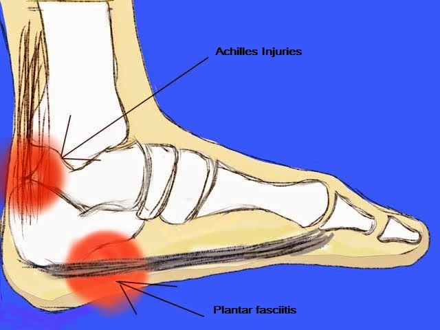 Achilles tendinitis - Symptoms and causes - Mayo Clinic