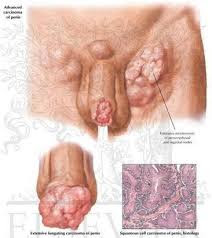 Foto Muncul Luka Pada Kepala Penis Penyakit Apa Ya,bagaimana mengobatainya