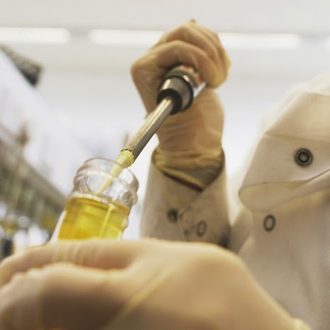 urine diabetic microalbumin nephropathy disease
