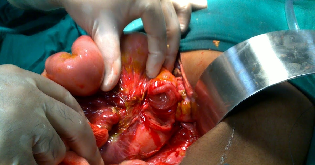 blunt injury to the hepatic flexture blunt injury to the hepatic flexture