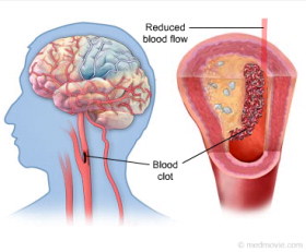 obat stroke obat stroke, obat herbal stroke, obat stroke alami