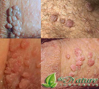 Jual Obat Kutil Kelamin Paling Ampuh Dan Aman Jual Obat Kutil Kelamin Paling Ampuh Dan Aman