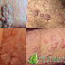 Jual Obat Kutil Kelamin Paling Ampuh Dan Aman Jual Obat Kutil Kelamin Paling Ampuh Dan Aman