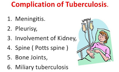 Tuberculosis ( T B ) - Respiratory Diseases