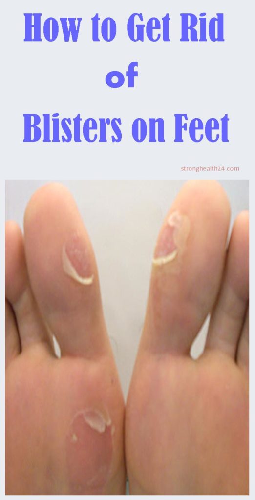 how to get rid of blisters on your feet quickly